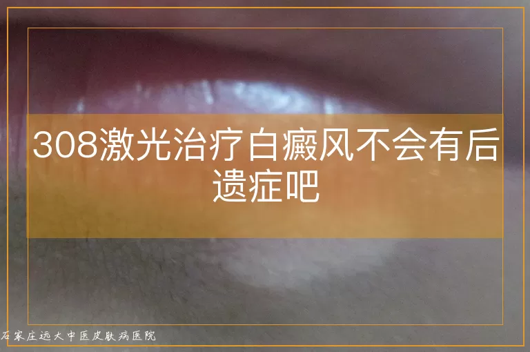 308激光治疗白癜风不会有后遗症吧