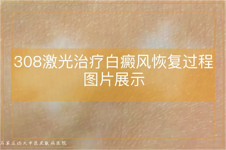 308激光治疗白癜风恢复过程图片展示