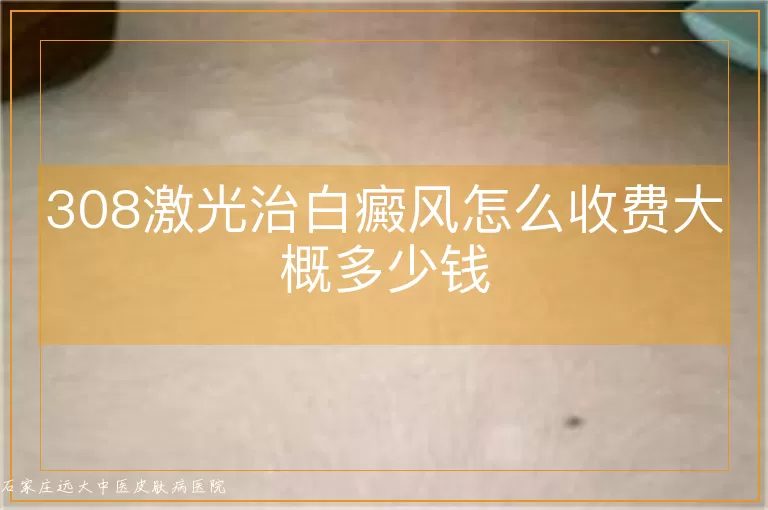 308激光治白癜风怎么收费大概多少钱