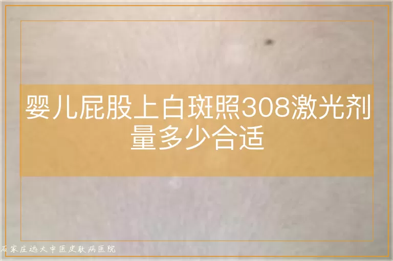 婴儿屁股上白斑照308激光剂量多少合适
