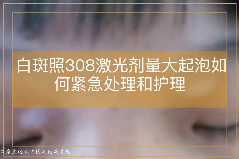 白斑照308激光剂量大起泡如何紧急处理和护理