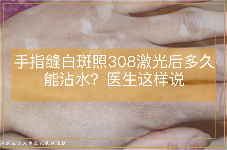 手指缝白斑照308激光后多久能沾水?医生这样说