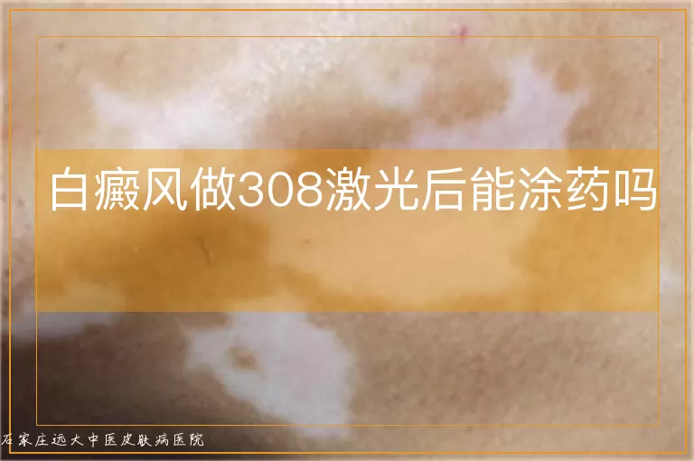 白癜风做308激光后能涂药吗