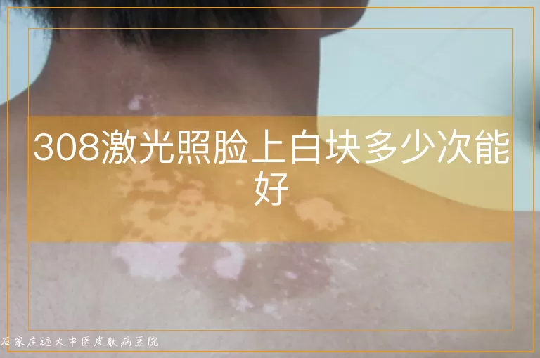 308激光照脸上白块多少次能好