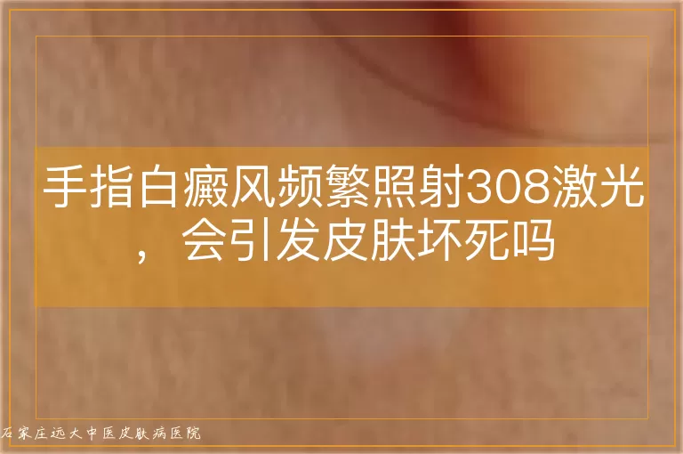 手指白癜风频繁照射308激光,会引发皮肤坏死吗