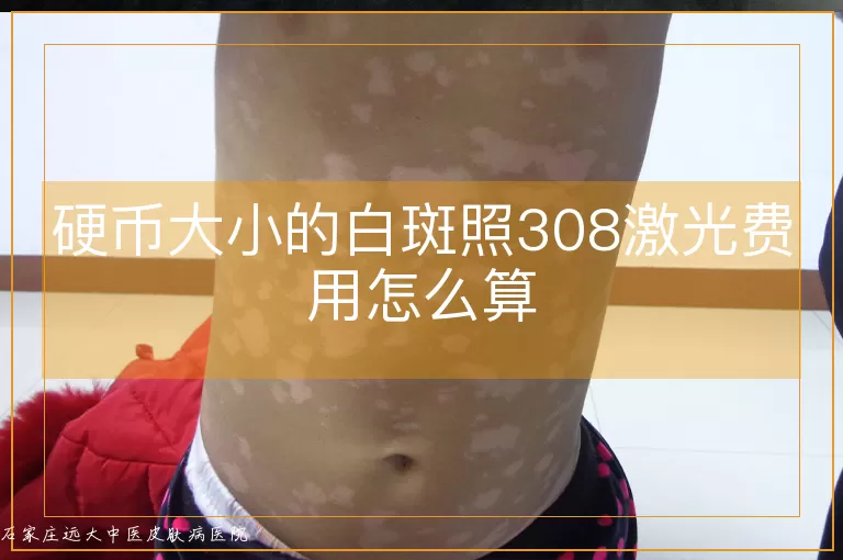 硬币大小的白斑照308激光费用怎么算