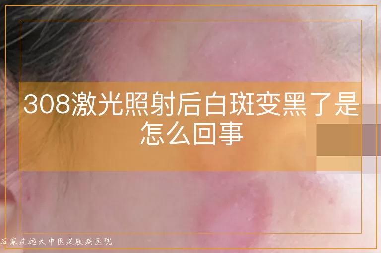 308激光照射后白斑变黑了是怎么回事