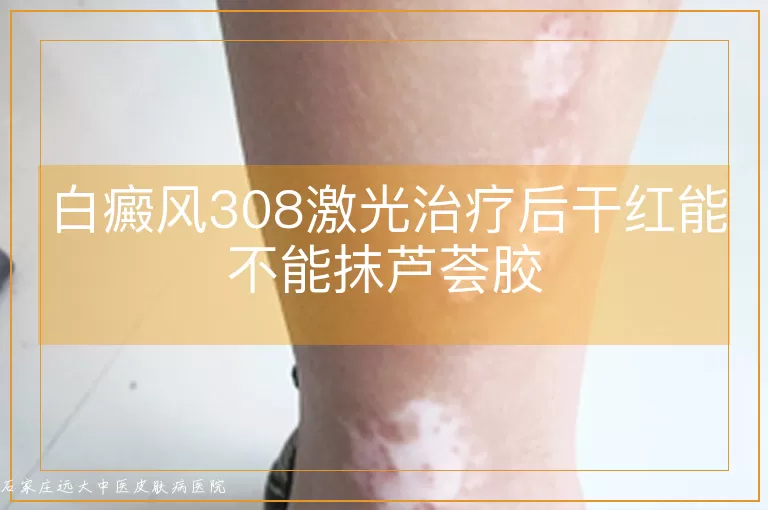 白癜风308激光治疗后干红能不能抹芦荟胶