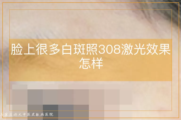 脸上很多白斑照308激光效果怎样