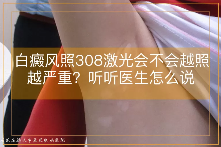 白癜风照308激光会不会越照越严重?听听医生怎么说