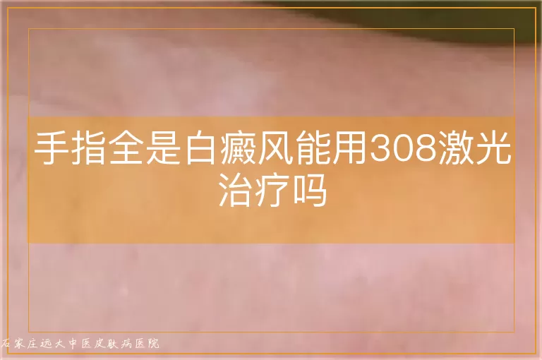 手指全是白癜风能用308激光治疗吗