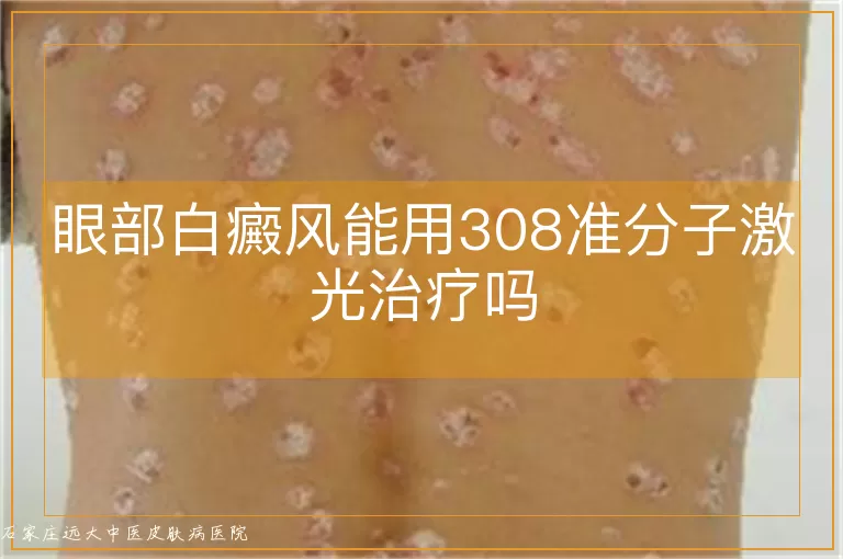 眼部白癜风能用308准分子激光治疗吗