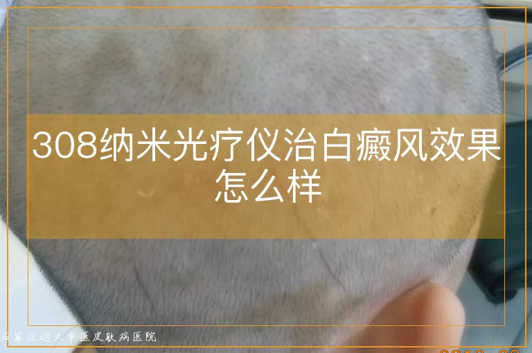 308纳米光疗仪治白癜风效果怎么样