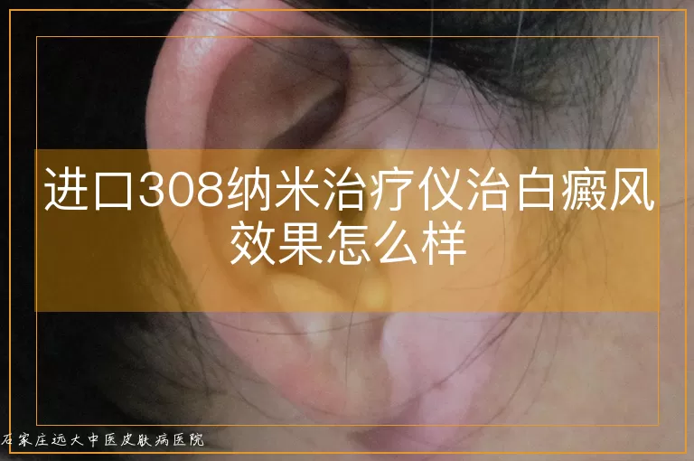 进口308纳米治疗仪治白癜风效果怎么样