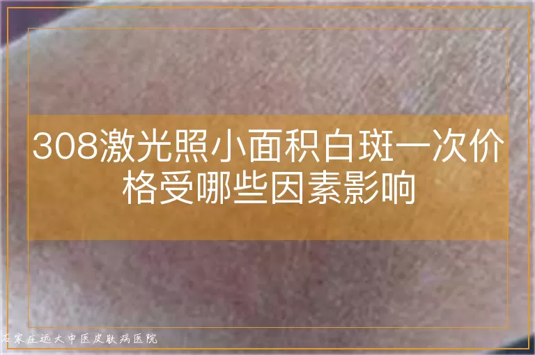 308激光照小面积白斑一次价格受哪些因素影响