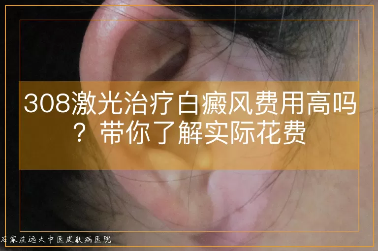 308激光治疗白癜风费用高吗？带你了解实际花费