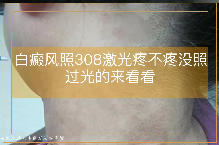 白癜风照308激光疼不疼没照过光的来看看