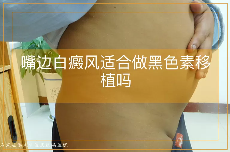 嘴边白癜风适合做黑色素移植吗