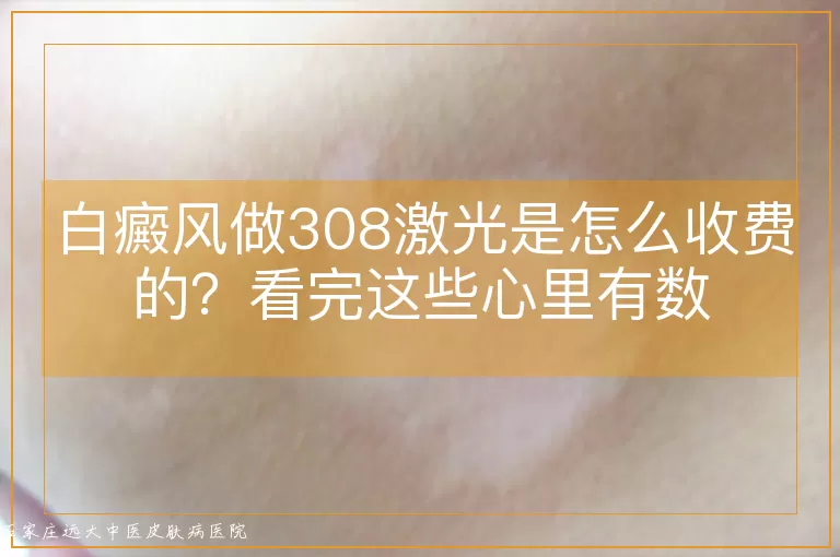 白癜风做308激光是怎么收费的?看完这些心里有数