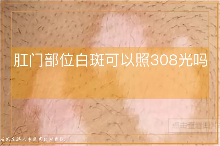 肛门部位白斑可以照308光吗