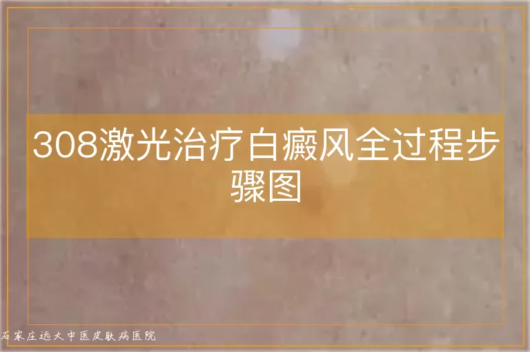 308激光治疗白癜风全过程步骤图