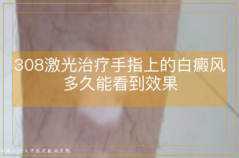 308激光治疗手指上的白癜风多久能看到效果