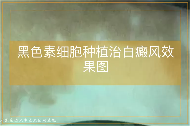 黑色素细胞种植治白癜风效果图