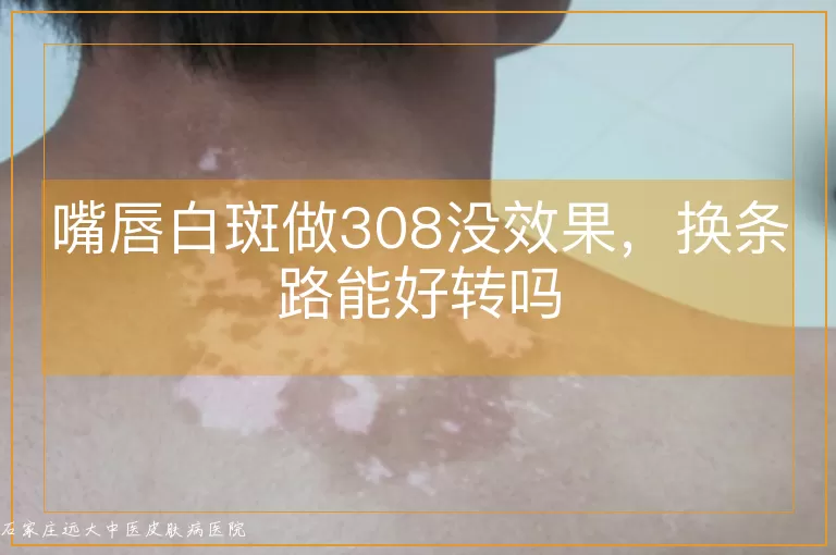 嘴唇白斑做308没效果,换条路能好转吗