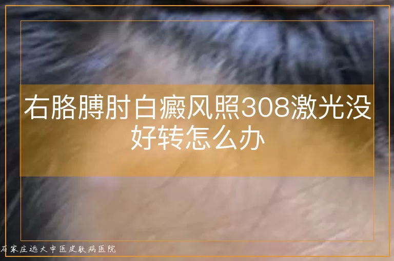 右胳膊肘白癜风照308激光没好转怎么办