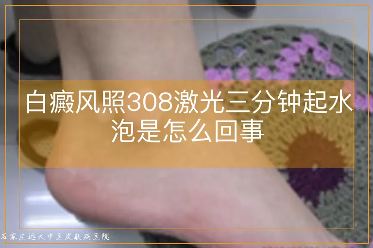 白癜风照308激光三分钟起水泡是怎么回事