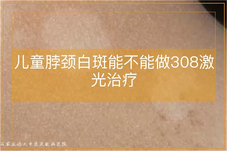 儿童脖颈白斑能不能做308激光治疗