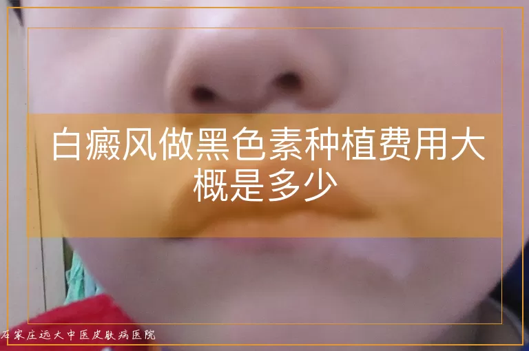 白癜风做黑色素种植费用大概是多少