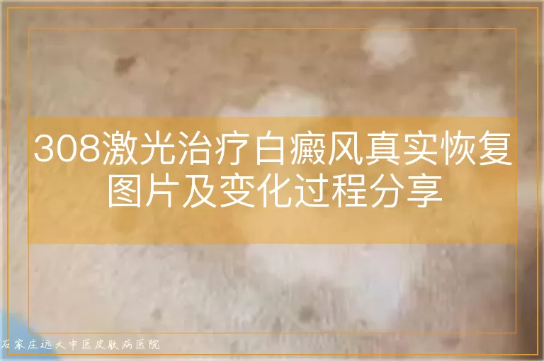 308激光治疗白癜风真实恢复图片及变化过程分享