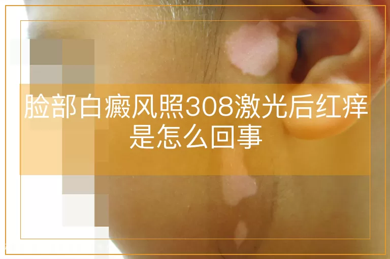 脸部白癜风照308激光后红痒是怎么回事