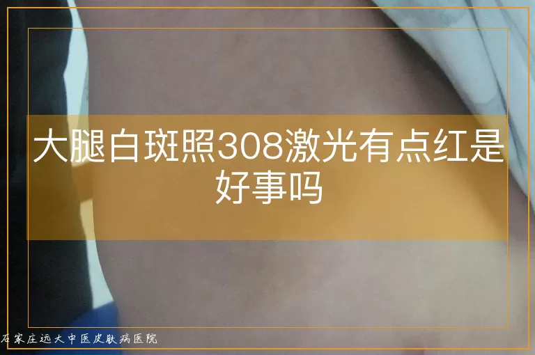 大腿白斑照308激光有点红是好事吗