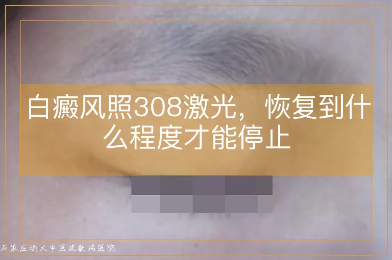 白癜风照308激光，恢复到什么程度才能停止