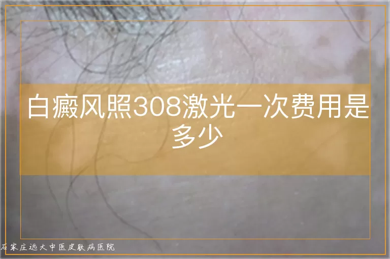 白癜风照308激光一次费用是多少