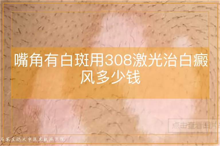 嘴角有白斑用308激光治白癜风多少钱