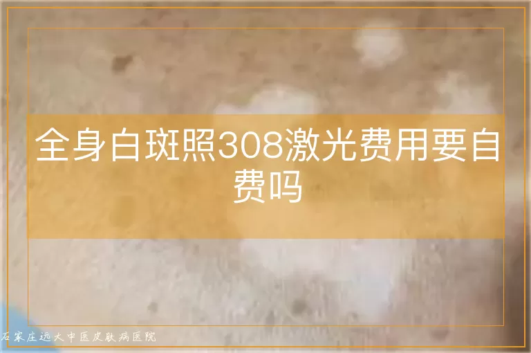 全身白斑照308激光费用要自费吗