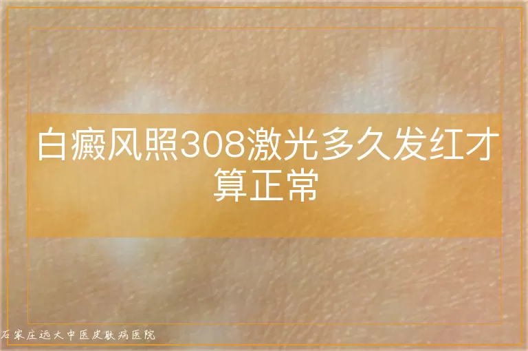 白癜风照308激光多久发红才算正常