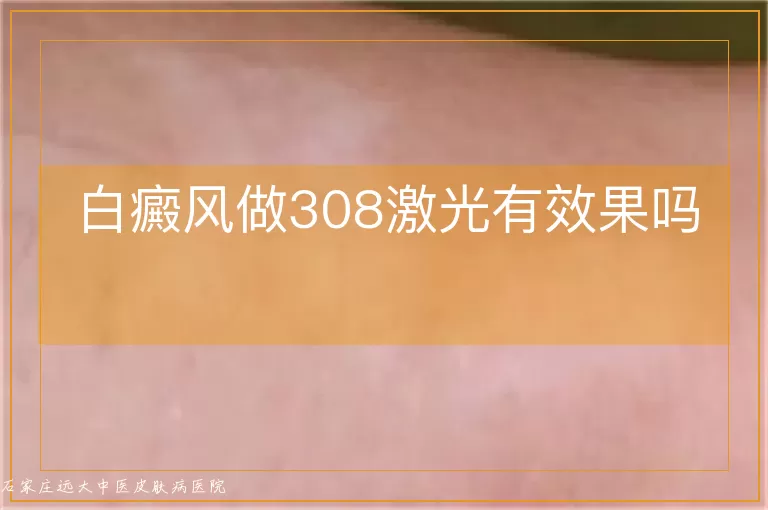 白癜风做308激光有效果吗