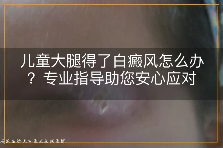 儿童大腿得了白癜风怎么办？专业指导助您安心应对