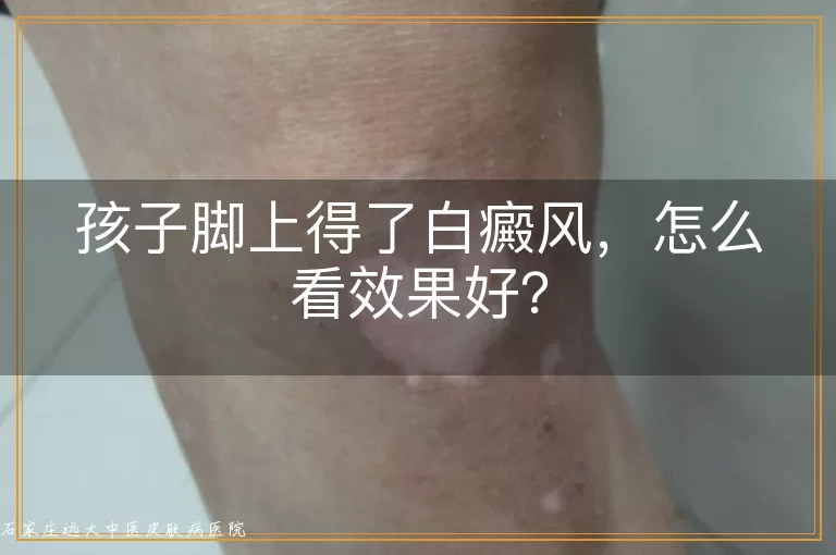 孩子脚上得了白癜风，怎么看效果好？
