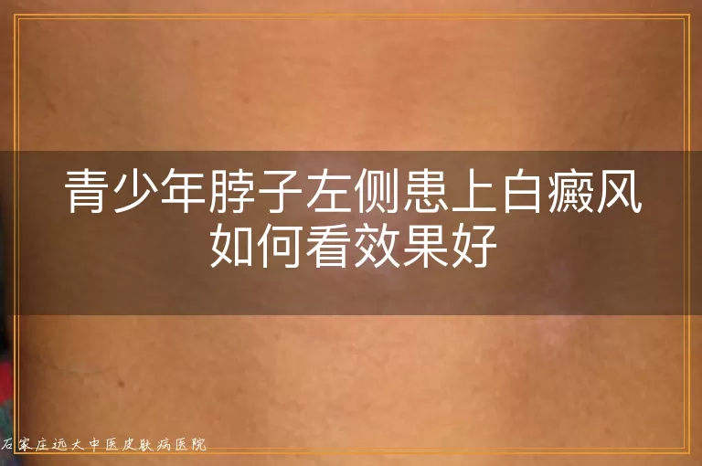 青少年脖子左侧患上白癜风如何看效果好