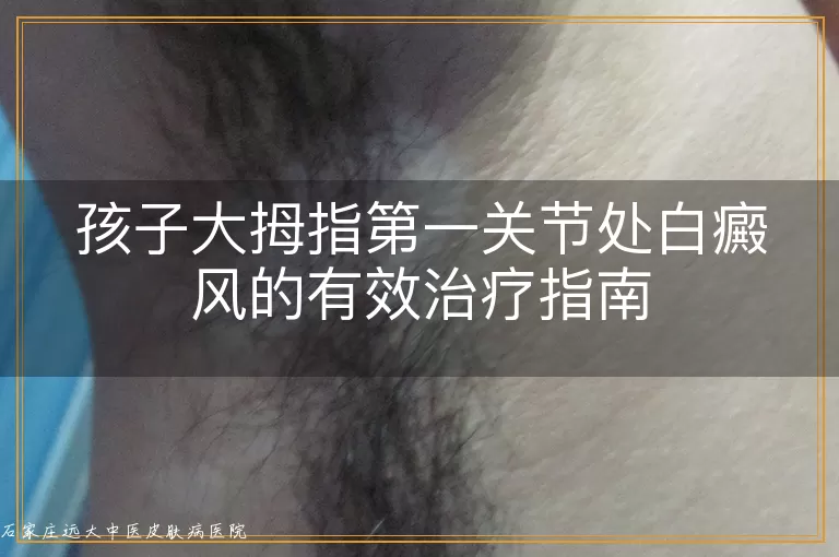 孩子大拇指第一关节处白癜风的有效治疗指南