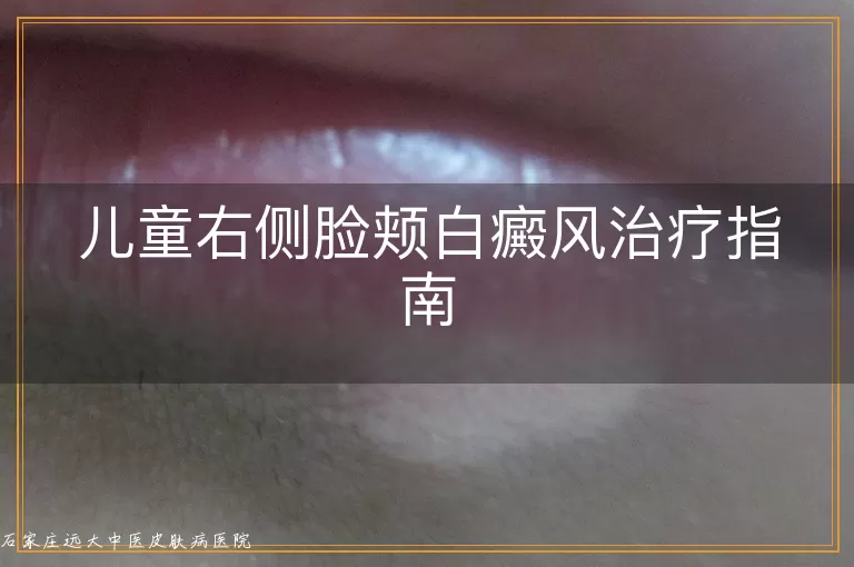 儿童右侧脸颊白癜风治疗指南