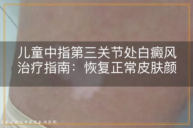 儿童中指第三关节处白癜风治疗指南：恢复正常皮肤颜色的方法