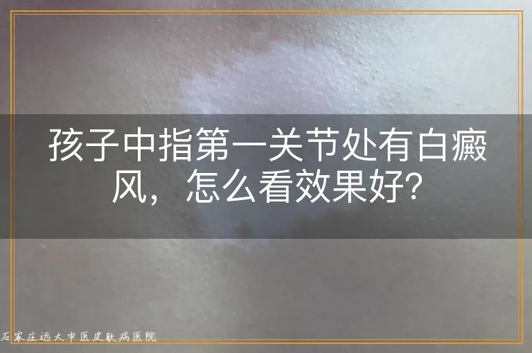 孩子中指第一关节处有白癜风，怎么看效果好？