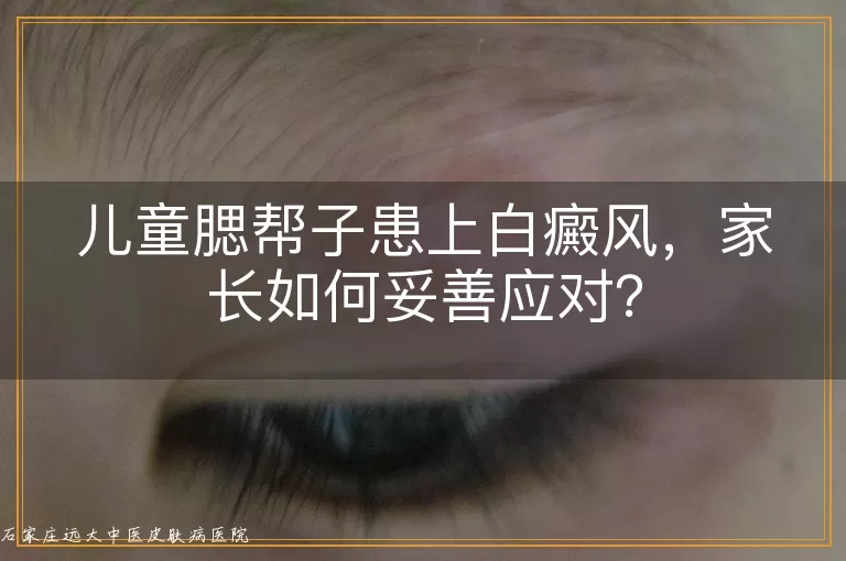 儿童腮帮子患上白癜风，家长如何妥善应对？