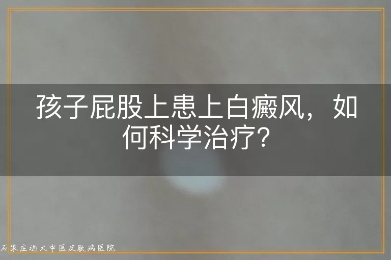 孩子屁股上患上白癜风，如何科学治疗？